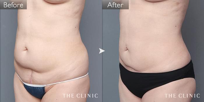 【美品】THE CLINIC ザクリニック脂肪吸引 圧迫着 お腹・腰・ウエスト Amazon.co.jp: [リポサポ LipoSup] 脂肪吸引専用お腹・腰