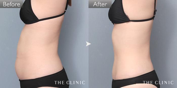 【美品】THE CLINIC ザクリニック脂肪吸引 圧迫着 お腹・腰・ウエスト 脂肪吸引「腰・ウエスト」の症例写真（35歳/女性）｜ザ