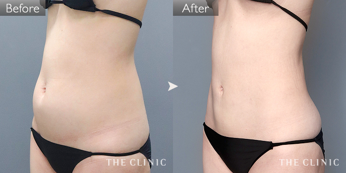 【美品】THE CLINIC ザクリニック脂肪吸引 圧迫着 お腹・腰・ウエスト 脂肪吸引「腰・ウエスト」の症例写真（30歳/女性）｜ザ