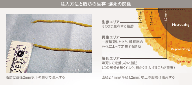 皮膚が引き締まる理由:温存された繊維組織が皮膚を引き締める