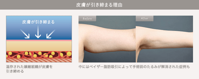 皮膚が引き締まる理由:温存された繊維組織が皮膚を引き締める