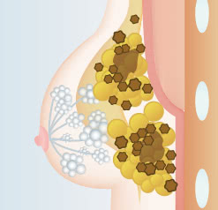 不純物を含んだ脂肪を注入した場合