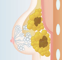 脂肪を塊で注入した場合
