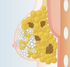大量の脂肪を注入した場合