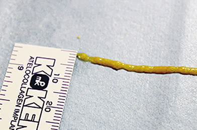 THE CLINIC が行う脂肪注入法(2.4mmヌードルインジェクション)