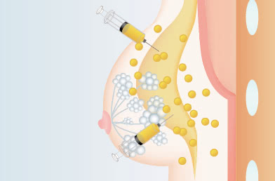 皮下、乳腺下、大胸筋内、大胸筋下と注入可能なあらゆる層へ、ごく少量ずつ分散注入します