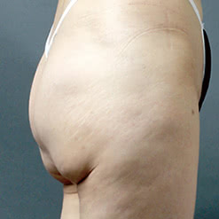 垂れてしまったお尻