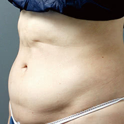 たるんでしまったお腹