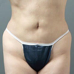 左右差が出てしまった腰