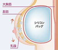 バスト内の豊胸シリコンバッグのイメージ