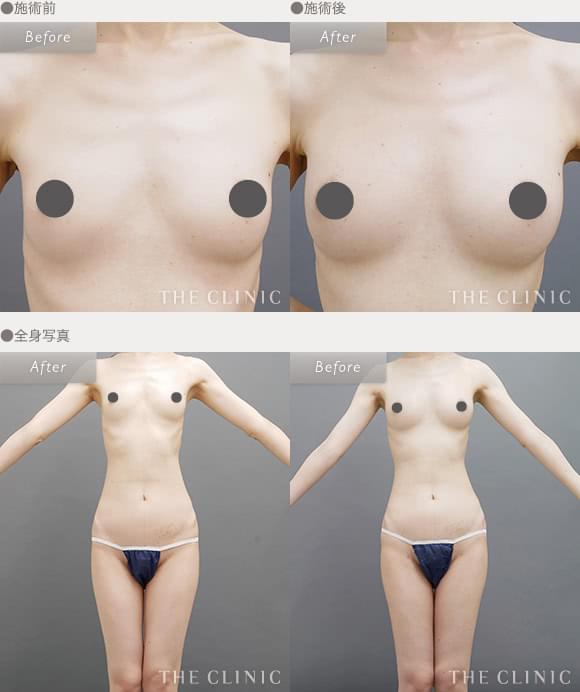 症例写真 / エクソソーム豊胸 | 全身写真