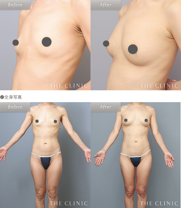 症例写真 / コンデンスリッチ豊胸 術前・術後 | 全身写真