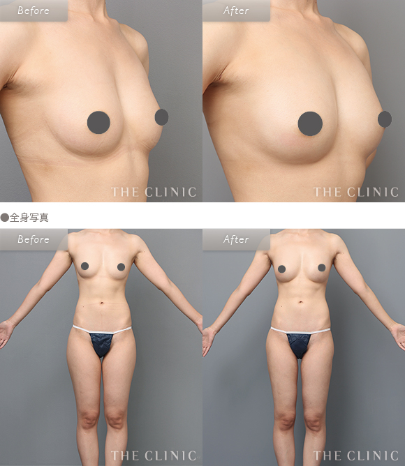 症例写真 / コンデンスリッチ豊胸 術前・術後 | 全身写真