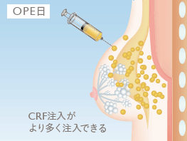 OPE日: CRF注入がより多く注入できる