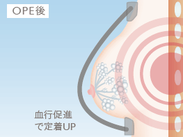 OPE後: 血行促進で定着UP