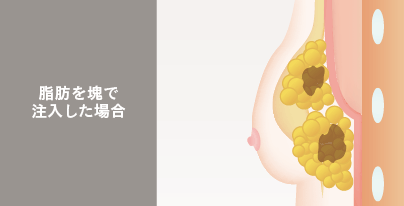 脂肪を塊で注入した場合