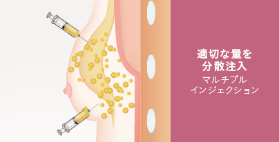 適切な量を分散注入 マルチプルインジェクション