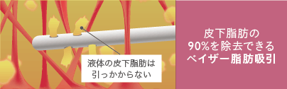 皮下脂肪の90%を除去できるベイザー脂肪吸引: 液体の皮下脂肪は引っかからない