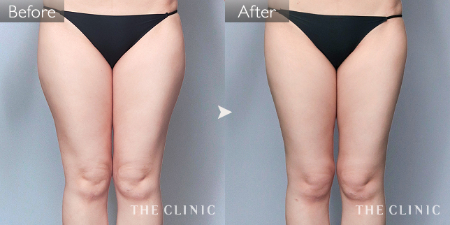 '症例写真 / ベイザー脂肪吸引 術前・術後