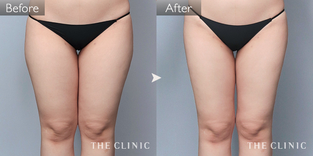 '症例写真 / ベイザー脂肪吸引 術前・術後