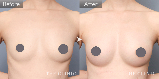 '症例写真 / コンデンスリッチ豊胸 術前・術後