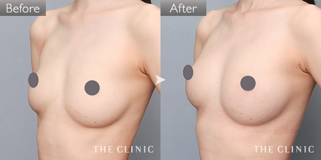 '症例写真 / コンデンスリッチ豊胸 術前・術後