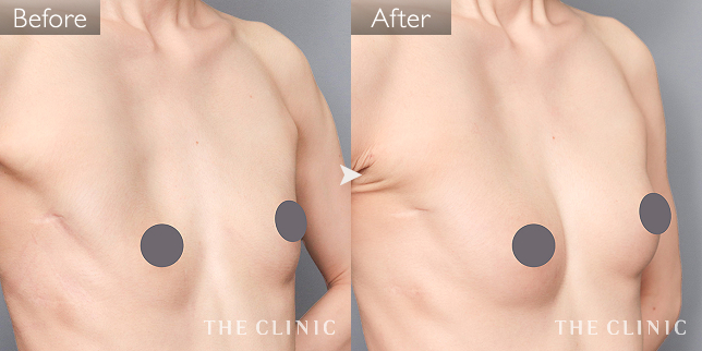 '症例写真 / コンデンスリッチ豊胸 術前・術後