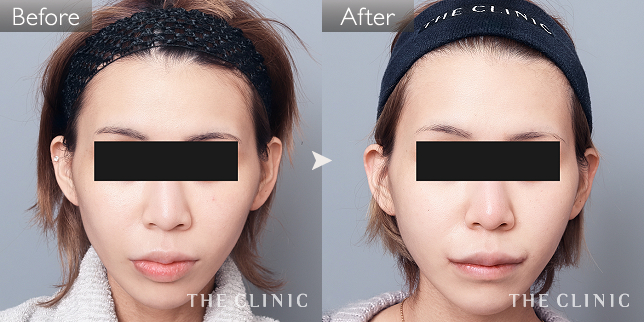 '症例写真 / コンデンスリッチフェイス(顔の脂肪注入) 術前・術後