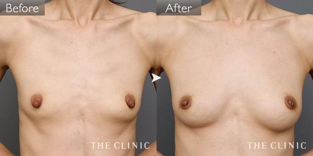 症例写真/ベイザー 脂肪吸引「ボリュームアップ」術前・術後