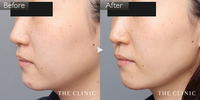 症例写真/ベイザー 脂肪吸引「頰/顎」術前・術後