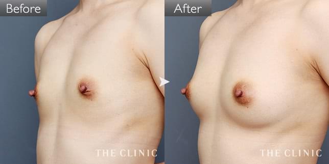 症例写真/ベイザー 脂肪吸引「授乳後のたるみ」術前・術後