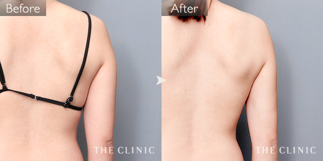 '症例写真 / ベイザー脂肪吸引 術前・術後