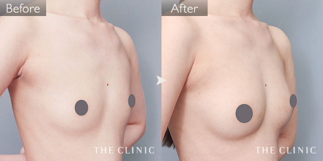 症例写真 / コンデンスリッチ豊胸 術前・術後