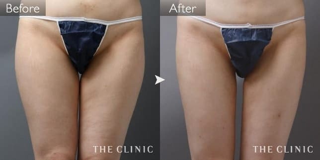 症例写真/ベイザー 脂肪吸引「太もも」術前・術後
