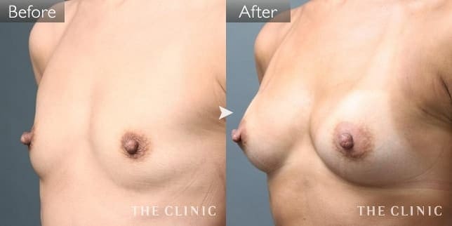 症例写真/ベイザー 脂肪吸引「授乳後のたるみ」術前・術後