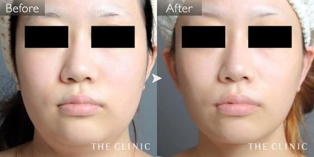 症例写真/ベイザー 脂肪吸引「頰/顎」術前・術後