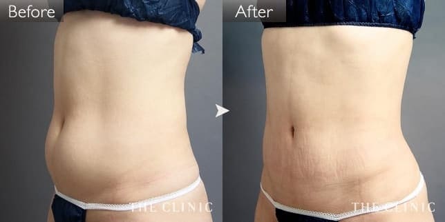 症例写真/ベイザー 脂肪吸引「腹部」術前・術後