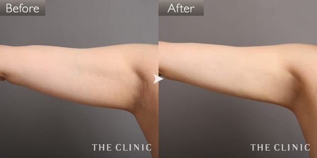 症例写真/ベイザー 脂肪吸引「二の腕」術前・術後