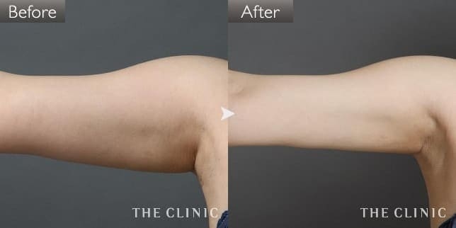 症例写真/ベイザー 脂肪吸引「二の腕」術前・術後