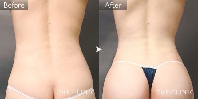 症例写真/ベイザー 脂肪吸引「腰・ウエスト」術前・術後