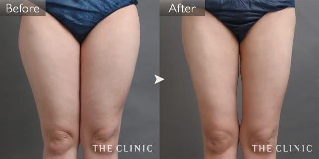 症例写真/ベイザー 脂肪吸引「太もも」術前・術後