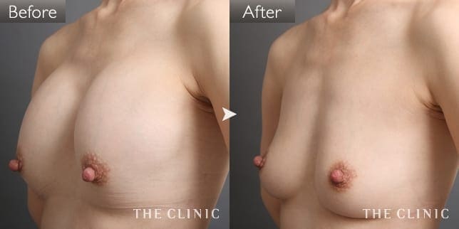 症例写真/ベイザー 脂肪吸引「シリコンバッグ抜去」術前・術後