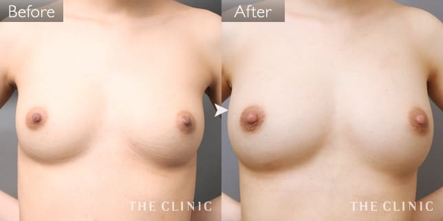 症例写真/ベイザー 脂肪吸引「ボリュームアップ」術前・術後