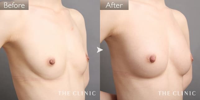 症例写真/ベイザー 脂肪吸引「ボリュームアップ」術前・術後