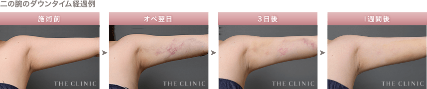 脂肪吸引後の経過例② 二の腕