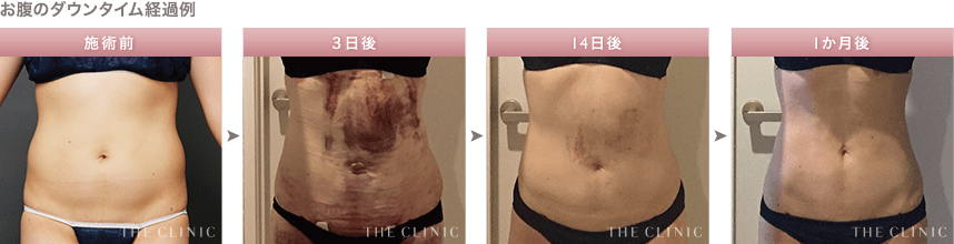 脂肪吸引後の経過例③ お腹