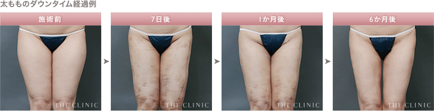 脂肪吸引後の経過例④ 太もも