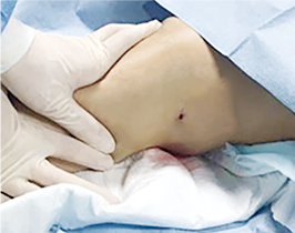 手術後は麻酔液をしっかり絞り出す