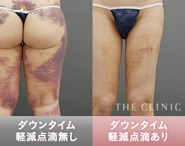 「ダウンタイム軽減点滴」でダウンタイムを大幅軽減