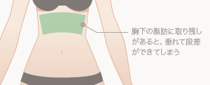 胸下の脂肪に取り残しがあると、垂れて段差ができてしまう